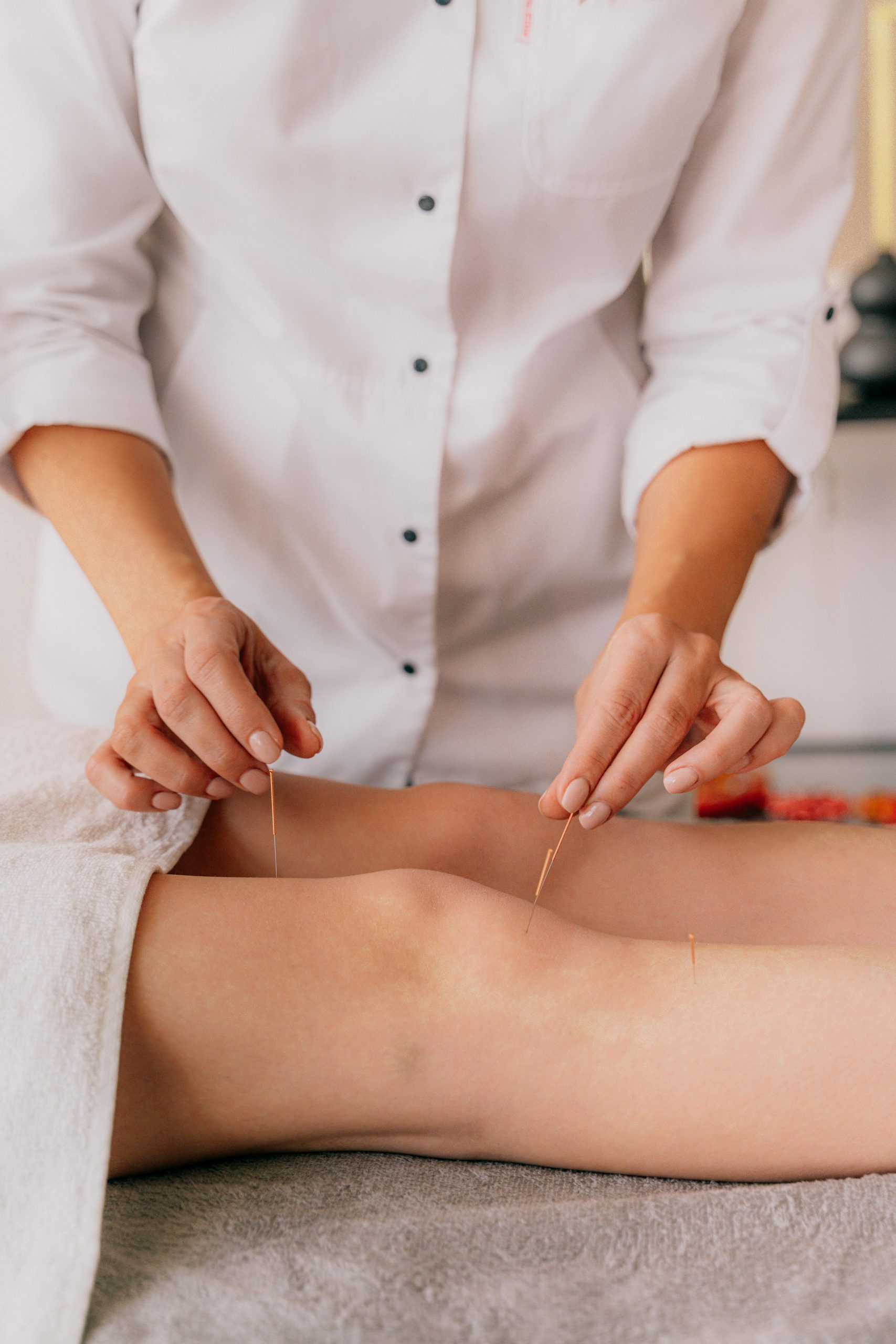 Acupuncture therapist putting needles on a patient's leg