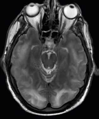 M R I scan of a brain with specific tumors.