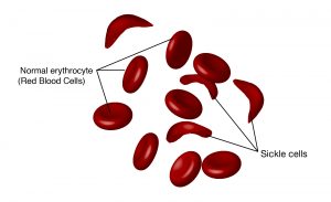 Illustration of normal and sickle cells. Normal red blood cells are round and sickle cells have a curved shape.