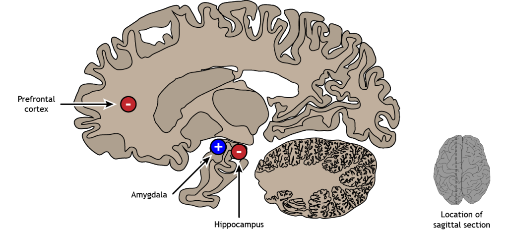 A sagittal brain section showing altered brain regions in PTSD. Details in text and caption.