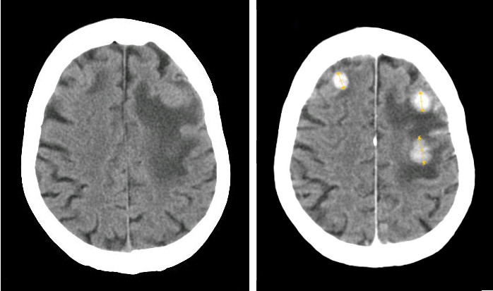 Example of a CT scan showing a black and white image of a horizontal image of the human brain. Some gyri and sulci are visible but the image produced does not show many details of anatomical structure.