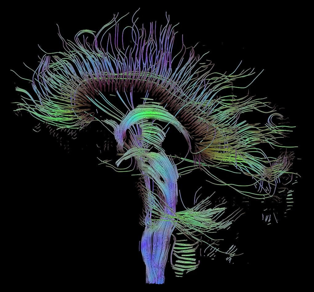 Diffusor tensor imaging example image showing connections in a midsagittal human brain. Connections are shown as colored lines.