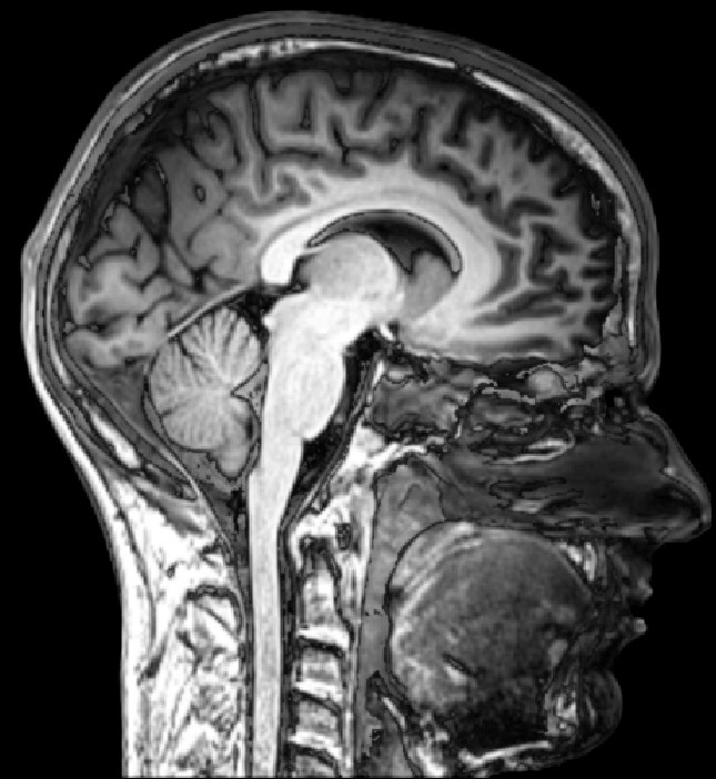 MRI scan of a midsagittal section of a human brain in black and white. Fine details are visible including the gyri, sulci, and subcortical structures.