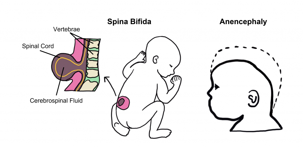 Image of the neural tube defects spina bifida and anencephaly. Details in caption and text.