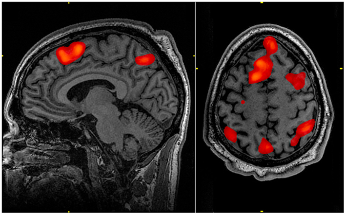 Example of a fMRI scan showing a midsagittal view and a horizontal view of the human brain. Increases in brain activity are indicated with red coloring on the anatomical locations of the increased activity.