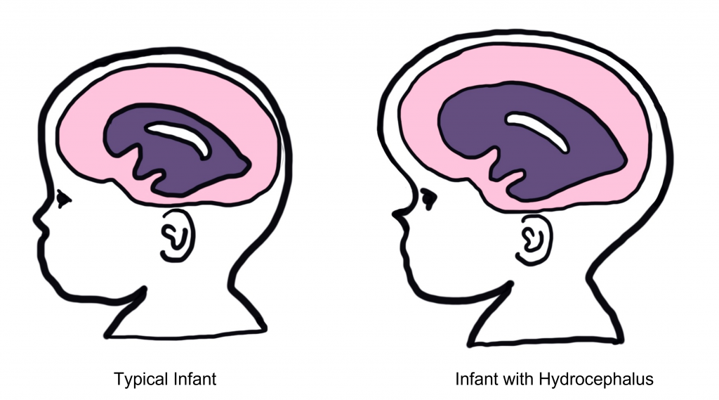 Image of a typical infant showing normal ventricle size. and an image of an infant with hydrocephalus showing enlarged ventricles.