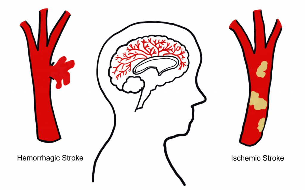 A hemorrhagic stroke is caused by a burst blood vessel that causes blood to leak into the brain. An ischemic stroke is caused by a clot in a blood vessel preventing the perfusion of blood to brain tissue