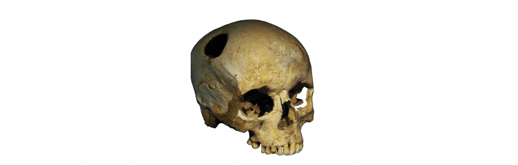 Image of trepanated skull