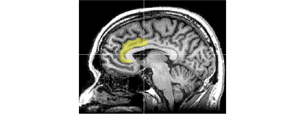 MRI image highlighting the anterior cingulate cortex. Details in the caption and text.
