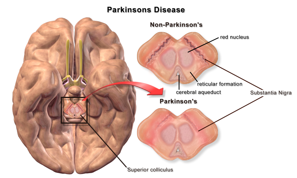 Image showing the location of the substantia nigra in the midbrain and the loss of dopaminergic cells in Parkinson's disease. Details in caption and text.