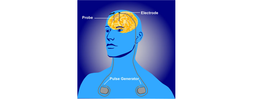 Image of deep brain stimulation device. Details in caption and text.