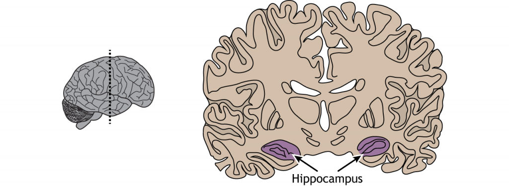 Illustration of a coronal section of the brain showing the location of the hippocampus in the temporal lobe.