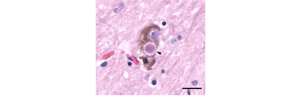 Microscope image of a Lewy body. Details in caption and text.