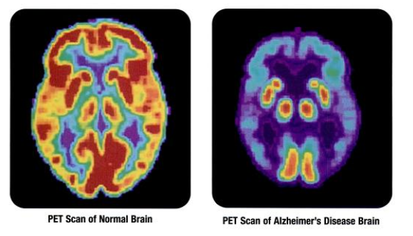 Image of two PET scans showing differences in brain activity between a normal brain and the brain from someone with Alzheimer's disease. The brain with Alzheimer's disease has far less activity than the normal brain. Details in caption.