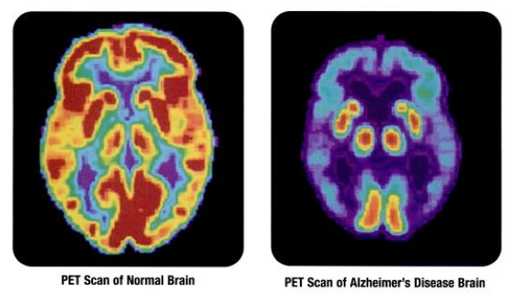 Image of two PET scans showing differences in brain activity between a normal brain and the brain from someone with Alzheimer&#039;s disease. The brain with Alzheimer&#039;s disease has far less activity than the normal brain. Details in caption.