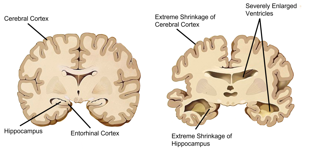 Image comparing brain structures between a normal brain and a brain from an individual with Alzheimer's disease. Details in caption and text.