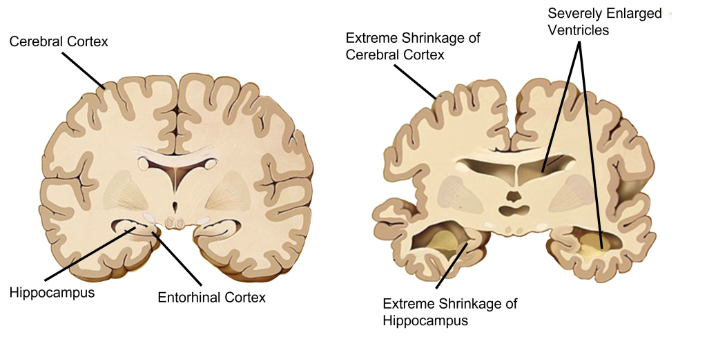 Image comparing brain structures between a normal brain and a brain from an individual with Alzheimer&#039;s disease. Details in caption and text.