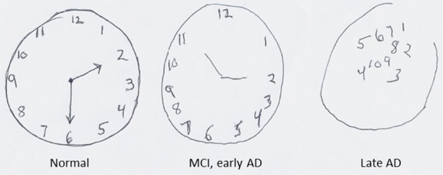 Image of three drawings from a normal patient, a patient with mild cognitive impairment, and one with late Alzheimer's disease. Details in caption.