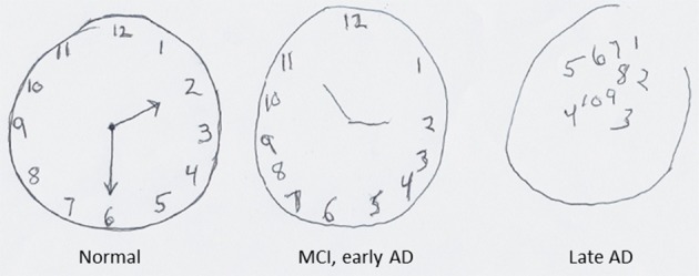 Image of three drawings from a normal patient, a patient with mild cognitive impairment, and one with late Alzheimer&#039;s disease. Details in caption.