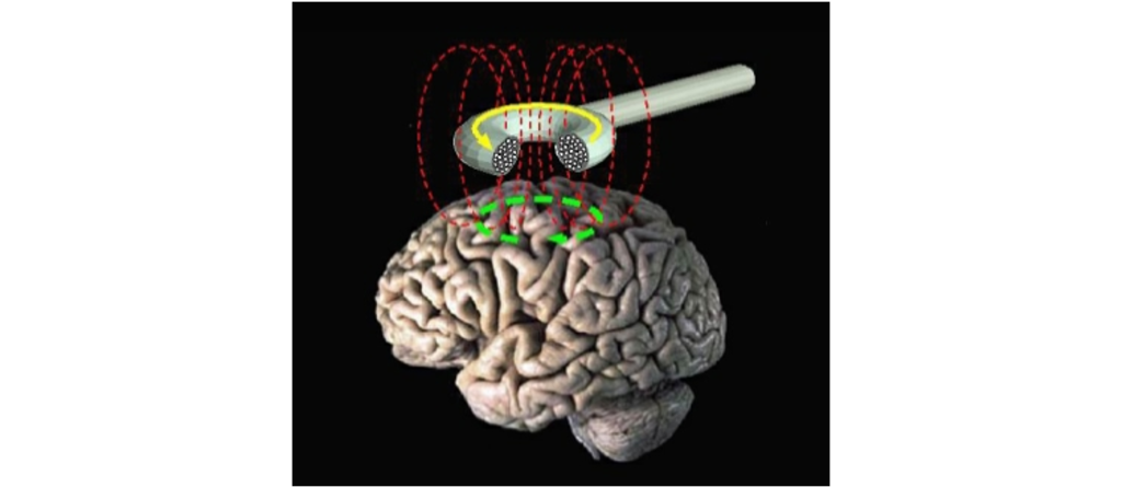 Transcranial magnetic stimulation uses a coil to alter electrical activity of brain tissue. Details in caption and text.