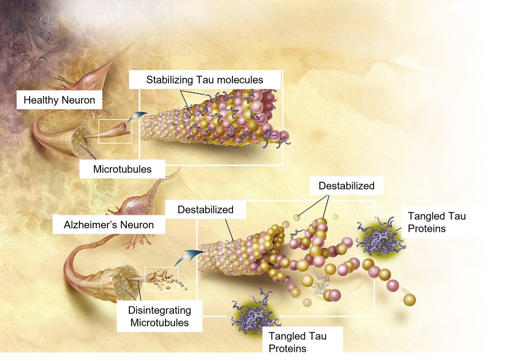 Image of Tau proteins in normal neurons and in neurons with Alzheimer&#039;s disease. Details in caption and text.