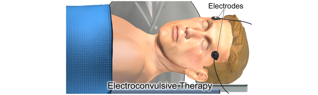 Image showing how electroconvulsive therapy is delivered.