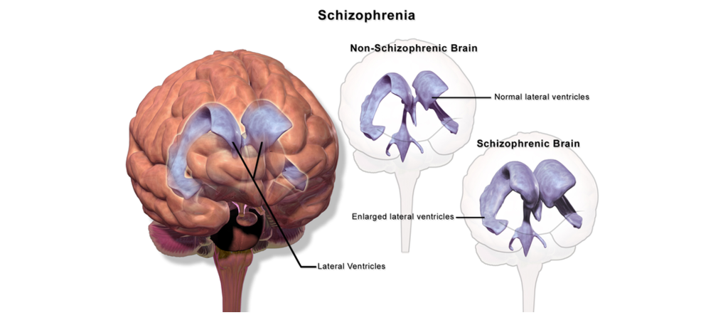 Image of the lateral ventricles in someone with schizophrenia and someone without schizophrenia. Details in caption and text.