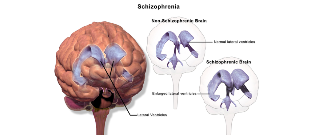 schizophrenia brain ventricles