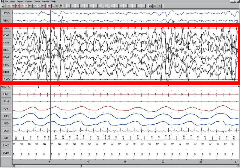 Screenshot of a sleep study recording showing multiple physiological signals. EEG channels display rhythmic brain wave activity. There are larger amplitude slower waves.