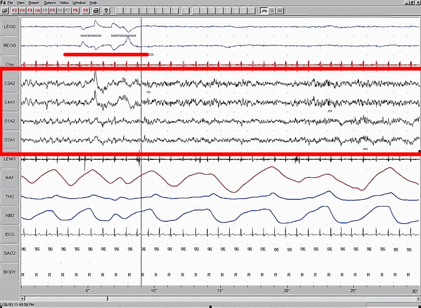 The red box highlights EEG waveforms characteristic of REM sleep. During REM, the EEG shows low-amplitude, mixed-frequency activity—similar to wakefulness. This combination helps identify REM sleep, where dreaming occurs.