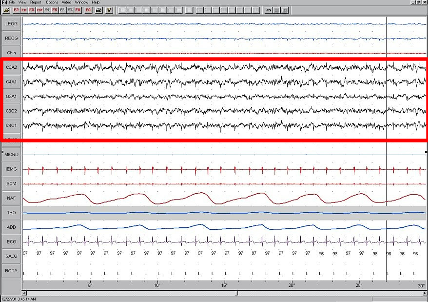 EEG recording showing Stage 1 sleep. EEG channels display low-amplitude, mixed-frequency brain waves, indicating light sleep.