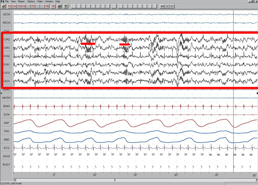 EEG recording showing multiple physiological waveforms during sleep. EEG channels (highlighted in red) display brain activity from various scalp locations. Small bursts of activity underlined in red indicate sleep spindles, and larger amplitude waves represent K-complexes—both features of Stage 2 non-REM sleep.